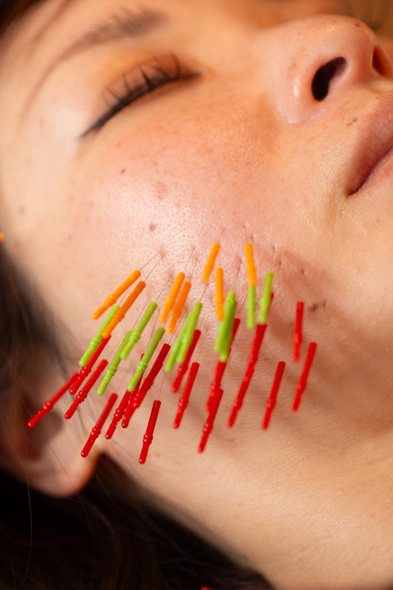 美容鍼施術中・顔に鍼が刺さった状態のアップ